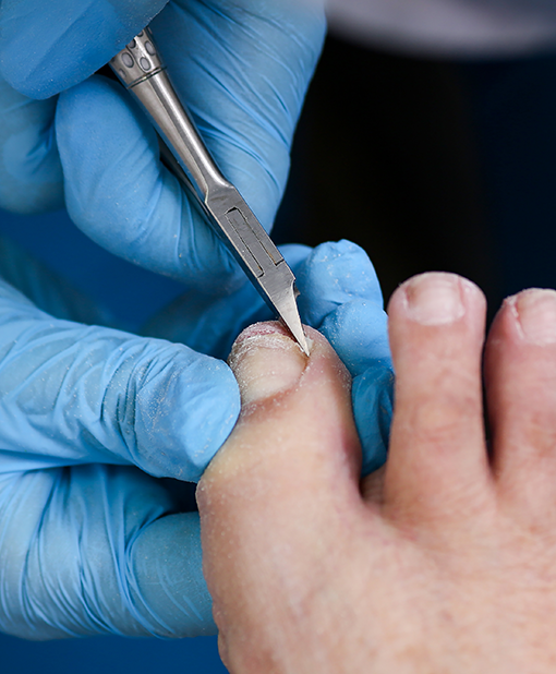 Medical professional in blue gloves using a scalpel to treat an ingrown toenail.