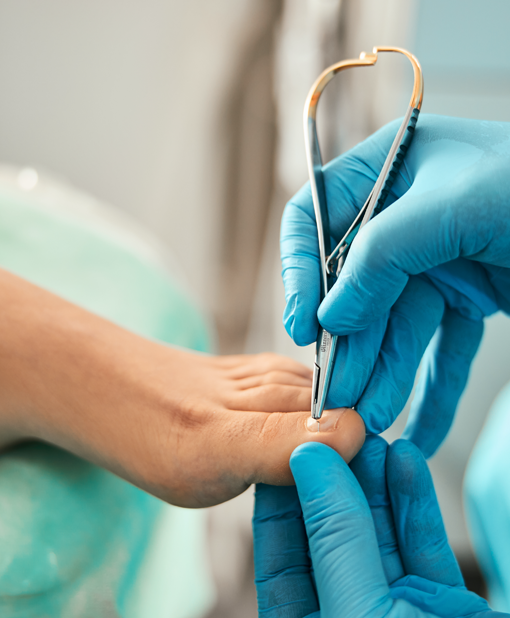 Gloved professional using nail nippers to trim a patient’s toenail during a foot care procedure.