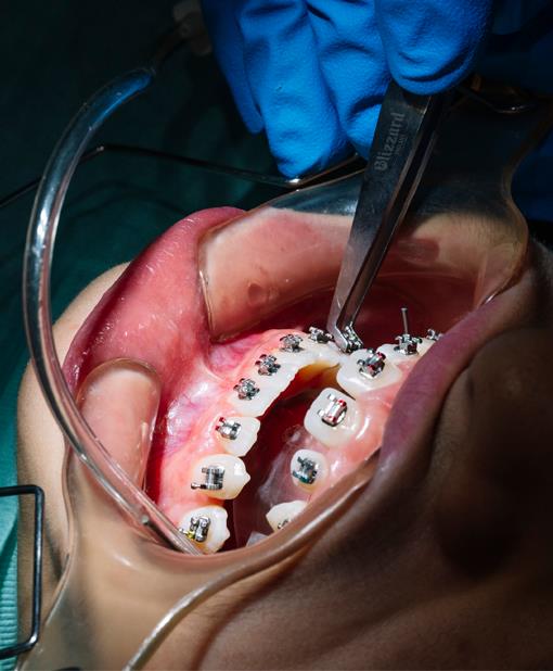 Orthodontist adjusting braces inside a patient’s mouth using dental instruments during a treatment procedure.